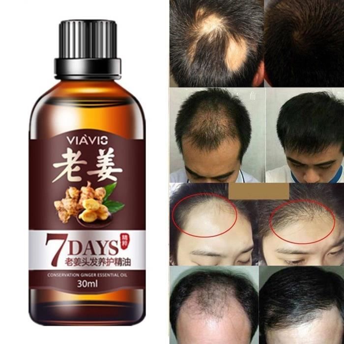 Rapide Croissance Des Cheveux Dense Repousse Ginger Serum Huile Anti Perte De Traitement Essence Bin Materiel De Fixation Cdiscount Au Quotidien