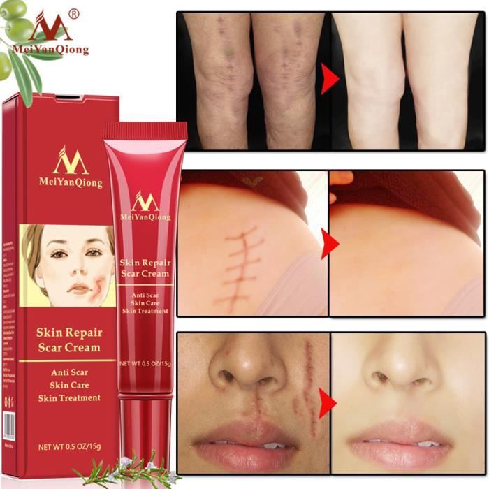 cream to remove nail marks from face