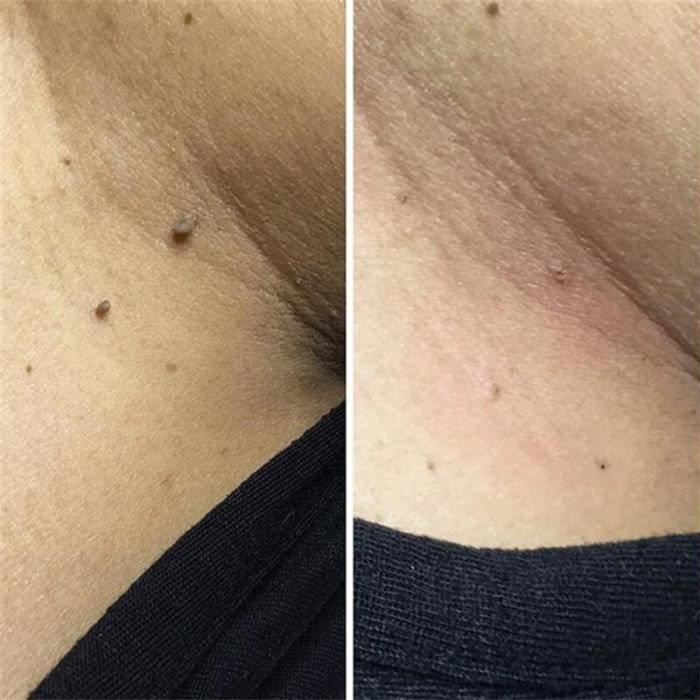 verrues génitales légères chez les hommes