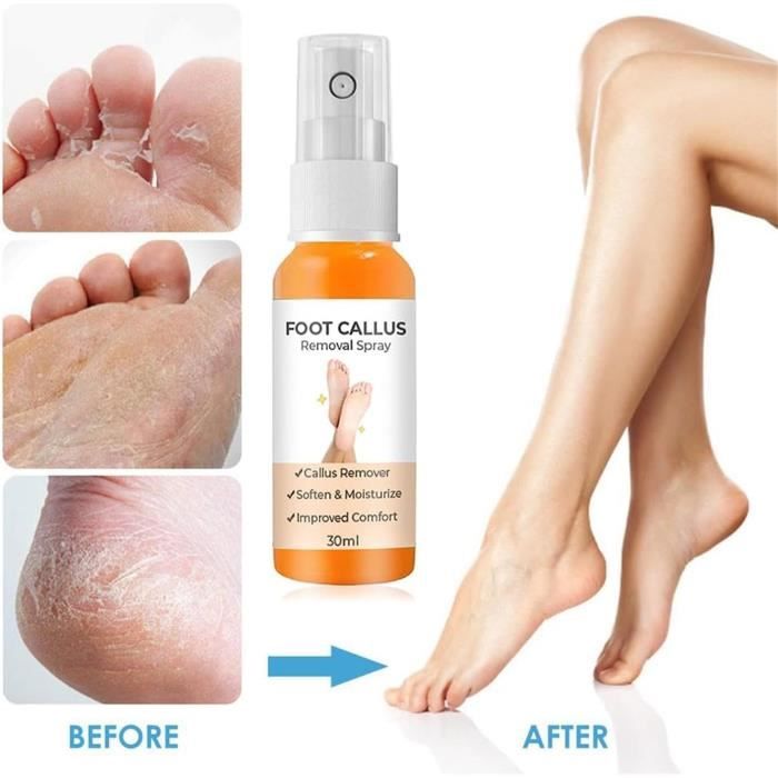 3 Pcs GFOUK Foot Callus Removal Spray, 30ml Foot Heel Callus Remover Spray,  Foot Exfoliating Spray - for Quickly Remove Dead Skin and Calluses on Feet