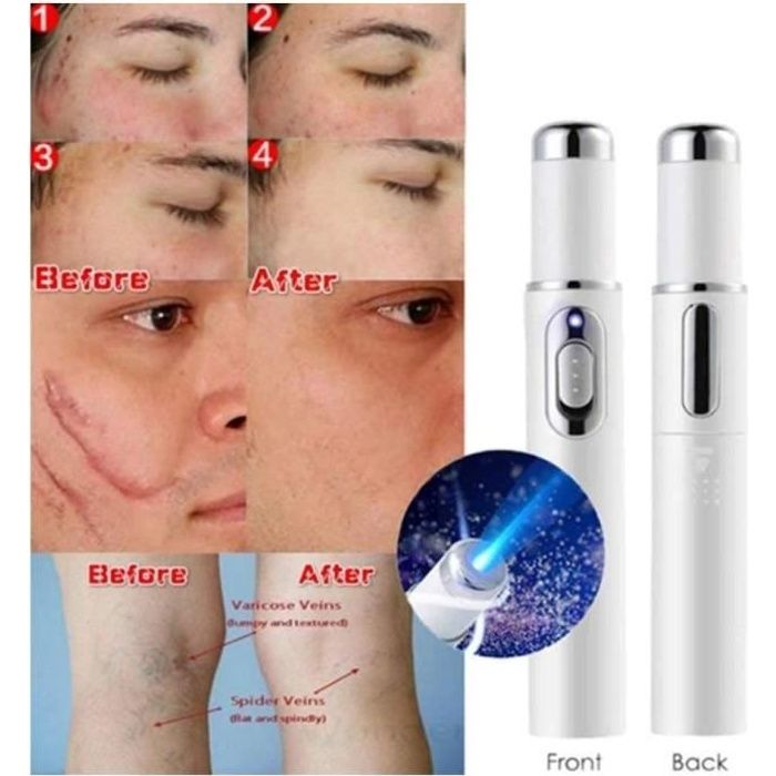Stylo Laser De Traitement Élimination des cicatrices, Blue Light Therapy Varices Pen Portable Wrinkle Scar Acné Remover Device