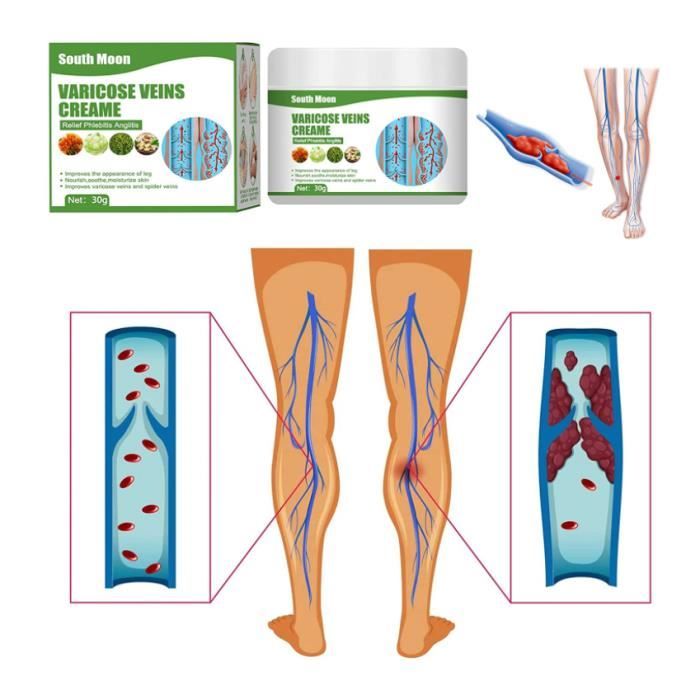 Varices Crème Araignée Veine Crème pour Jambe Varices Traitement Jambes — free download