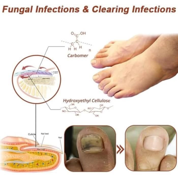 Appareil Laser De Traitement Des Mycoses Des Ongles Des Pieds – Nettoyage Et Réparation, Marque Quattro