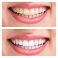Stylo MEAWHITE – Blanchiment dentaire - PLASTIMEA-1