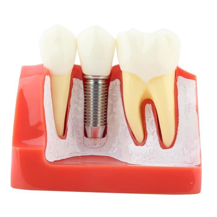 VGEBY Modèle de dents 1pc résine démonstration dentaire modèle de dent  analyse d'implant pont de couronne pour dentiste