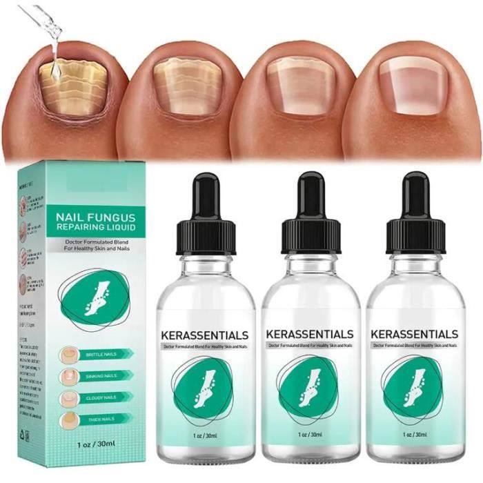 Upgrade Kerassentials Toenail Fungus Treatment Oil, Kerasentials Nail Treatment, Strengthen and Moisturize The Nails (3PCS) - Cdiscount Electroménager