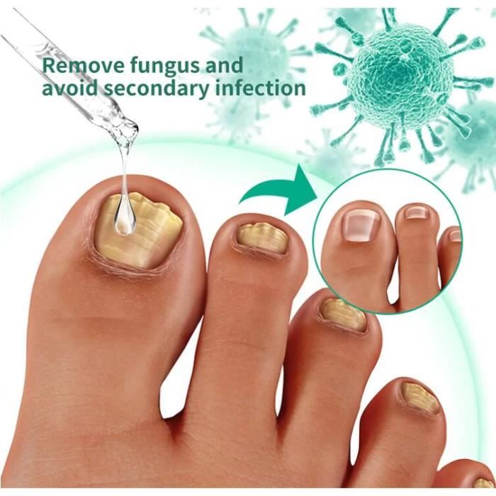 Upgrade Kerassentials Toenail Fungus Treatment Oil, Kerasentials Nail Treatment, Strengthen and Moisturize The Nails (3PCS) - Cdiscount Electroménager