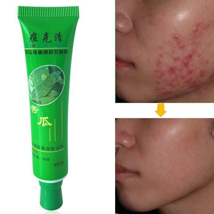1 Pcs 30g visage peau réparation acné crème contrôle de l'huile acné remover soins de la peau du visage A55525