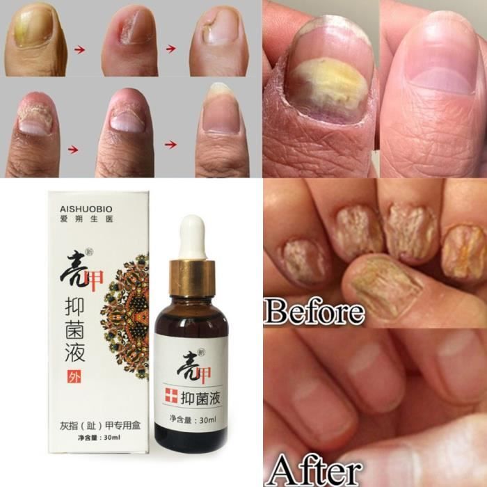 Dissolvant d'onychomycose de nettoyant liquide de réparation d'ongle de soins de la peau de santé LIA80723082_0169