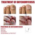 50ML Mycose Ongles Des Pieds,Mycose Ongle,Traitement Mycose Ongle Pied,Traitement Ongles,Solution Pour Les Ongles Décoloré-2